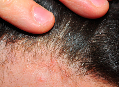 Dermatite del cuoio capelluto: cause e rimedi efficaci